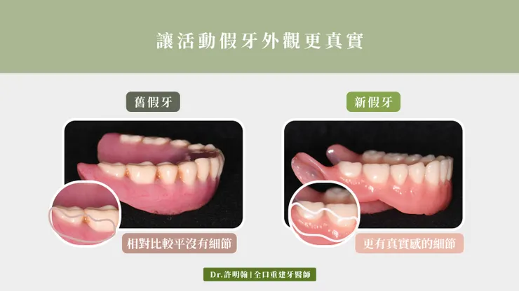 讓活動假牙外觀更真實