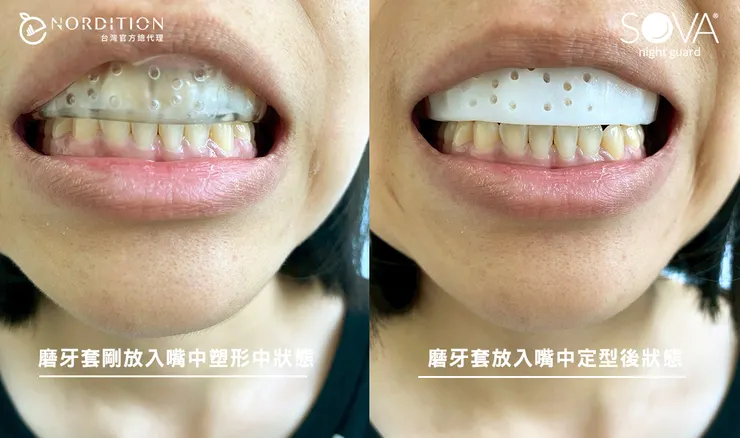 SOVA® 3D防磨牙牙套 ▁  塑形中