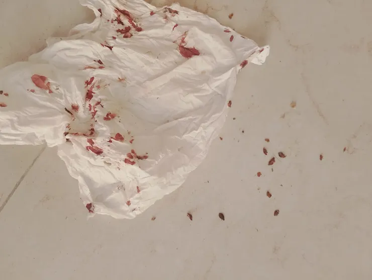 床蝨咬人後︳用紙巾禁死的血漬