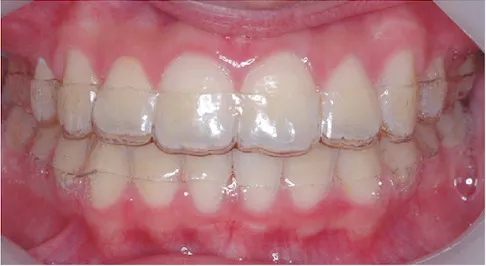 透明維持器（clear oerlay）口內照，跟隱形牙套很像吧