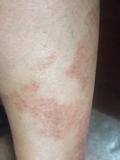 濕疹治療-有圖小心,吃飯不要看