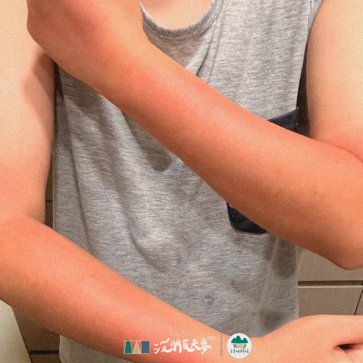 紀念品:曬傷的肌膚