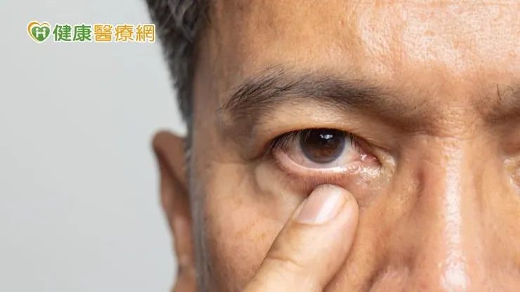 青光眼是一種可能致盲的視神經病變，又被稱為「視力小偷」，由於早期幾乎沒有明顯症狀，患者常常毫無察覺就逐漸喪失視力。