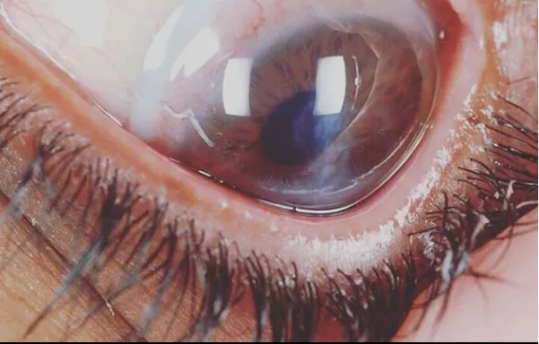 Munson氏徵象—EYEdolairy DEFPOTEC