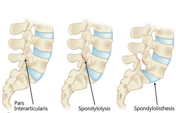 左:正常;中:椎弓斷裂;右:椎弓滑脫