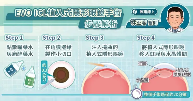 EVO ICL 新型植入式隱形眼鏡手術步驟解析