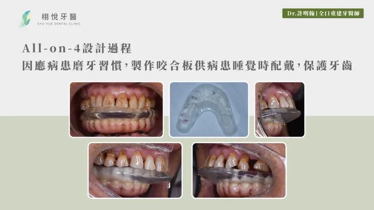 All-on-4設計過程：因應病患磨牙習慣，製作咬合板供病患睡覺時配戴，保護牙齒