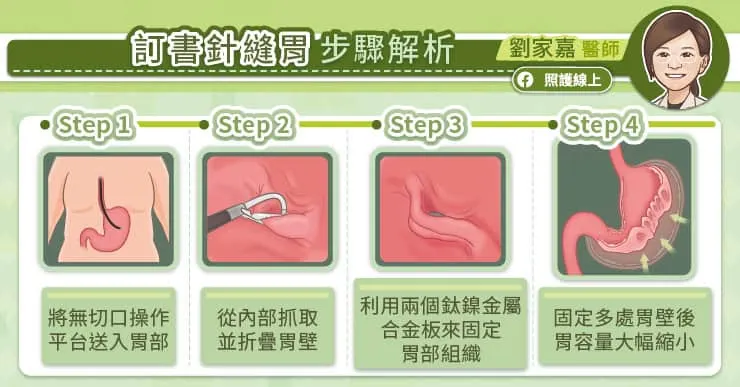 訂書針縫胃手術步驟解析