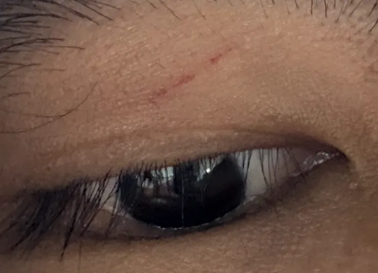 2025/10/16 眼皮抓痕