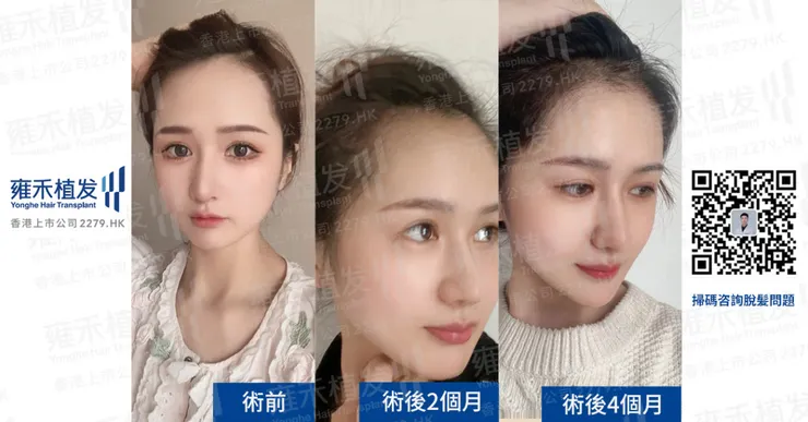 植髮效果