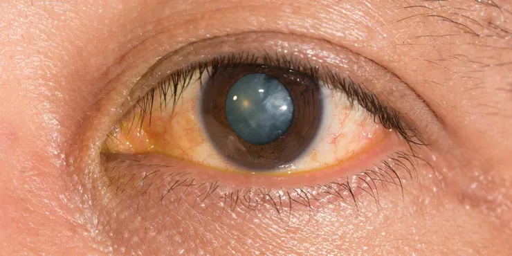 Age-Related Nuclear Cataract-nearetina