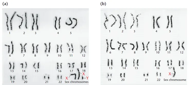 (a) 克氏症候群 (47,XXY)  (b) 透納氏症 (45,X).圖片取自Concepts of Genetics 3th EDITION