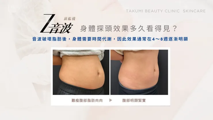 年後小腹回不去？別急著抽脂！Z音波溶脂才是對付「局部年後肥」的聰明選擇！