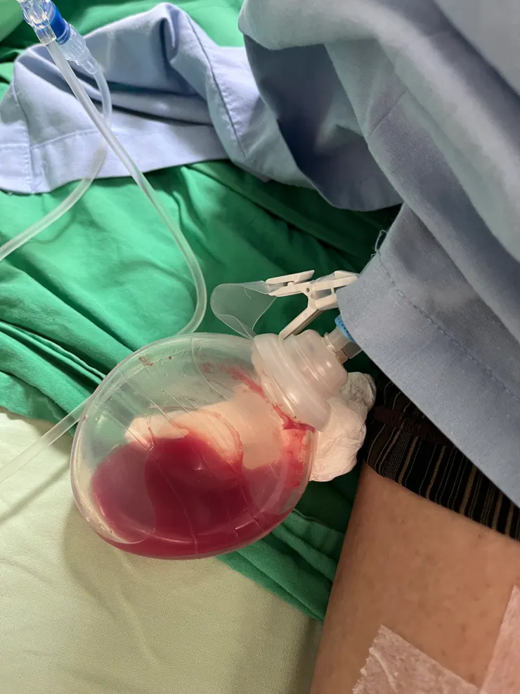 腹腔引流管接的手榴彈型瓶