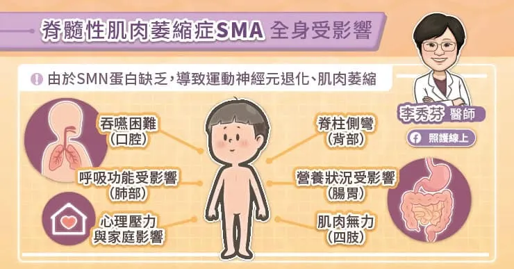 脊髓性肌肉萎縮症（SMA）全身受影響