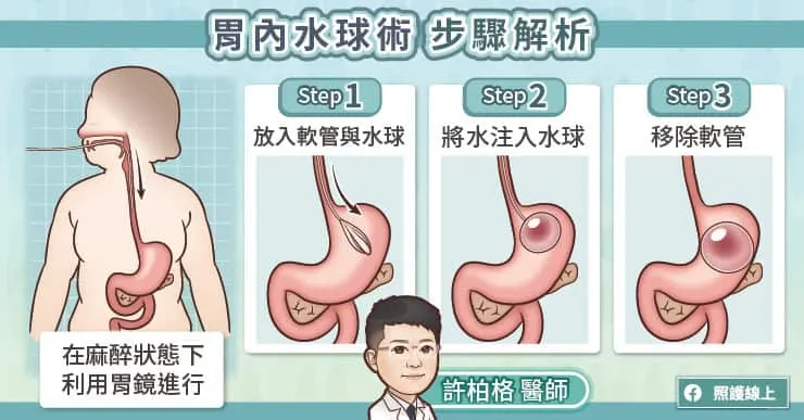 胃內水球術步驟解析