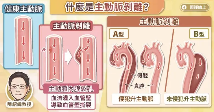 什麼是主動脈剝離