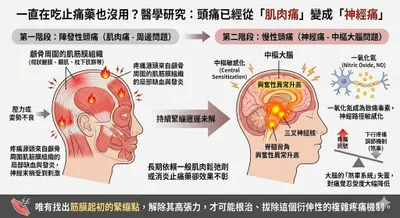 當頭痛已經從「肌肉痛」變成「神經痛」