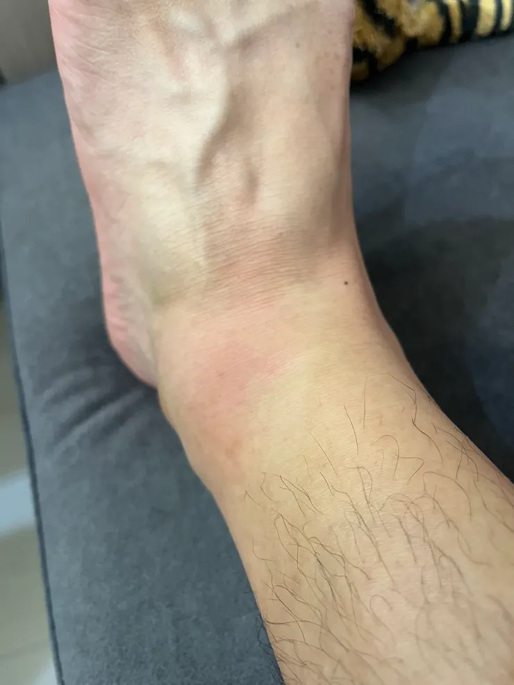 腫起來的腳踝