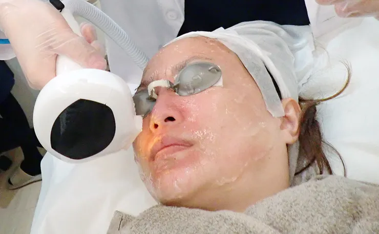 台北打皮秒│探索皮秒+蜂巢(超級鏡片ReFIX)-台北醫美診所推薦