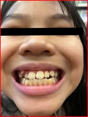 照正面時，記得要正常咬合（咬後面），才能看出、評估平常的咬合狀態，此圖是錯誤示範，她往前咬了，這是常見的拍照錯誤