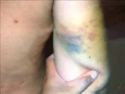 吳金女的瘀青,警方資料照