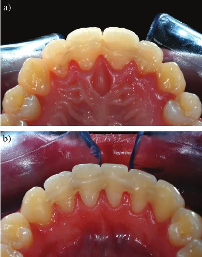 上圖是上顎,下圖是下顎