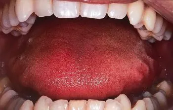 有時我會照一些特寫，記錄我看到的不正常處，例如這張是表現大舌頭齒痕