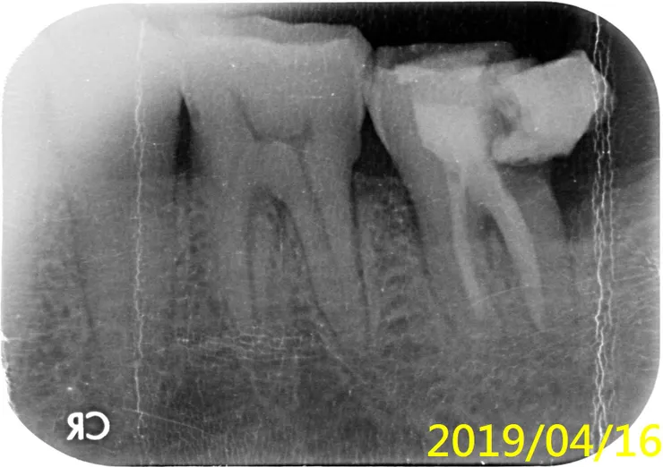一年後,病人回來說,補的掉了