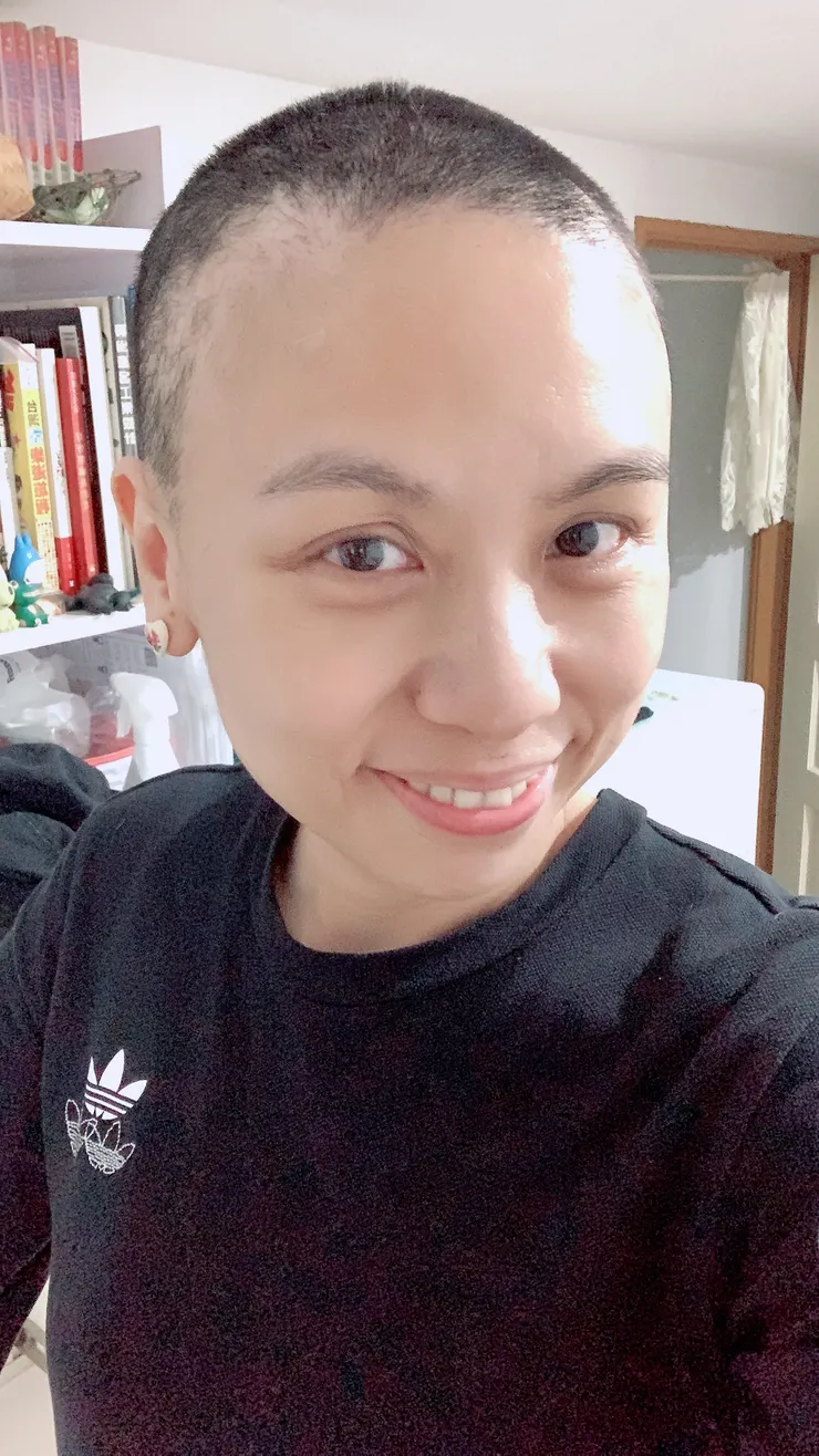 M字的地方掉髮比較多