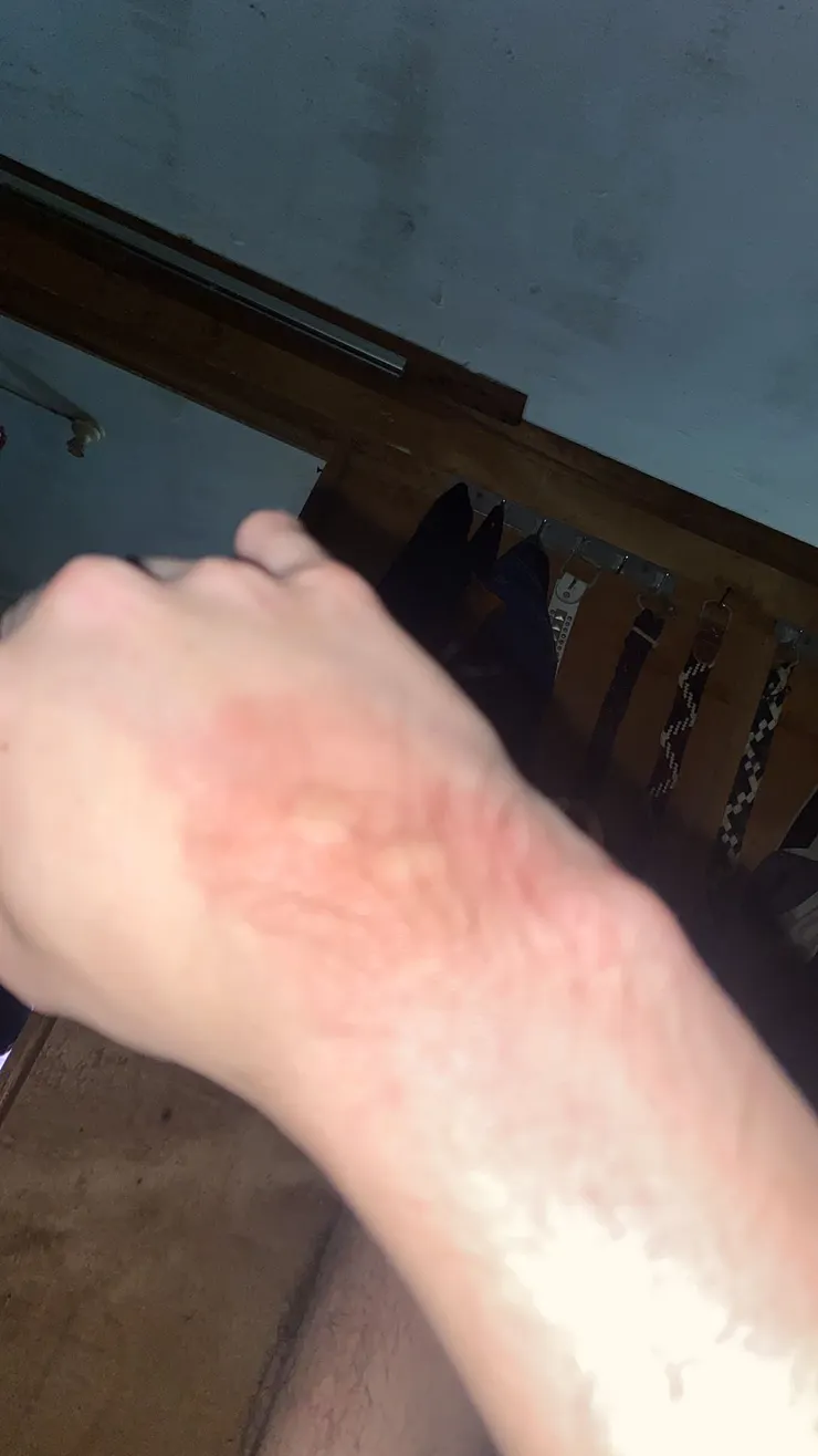 「手臂出現床蝨咬痕，紅腫成列排列，一晚多處中招