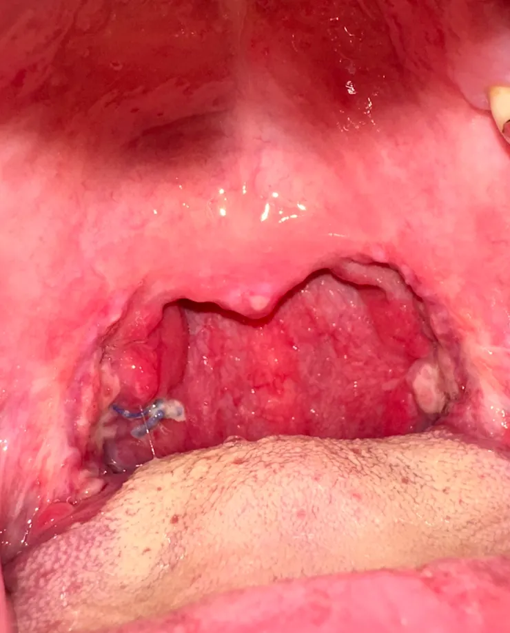 3週後已經好差不多了