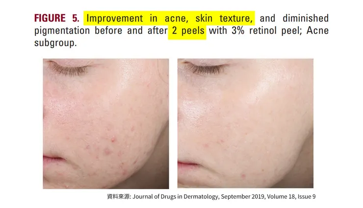 「A醇」現代抗老神器！