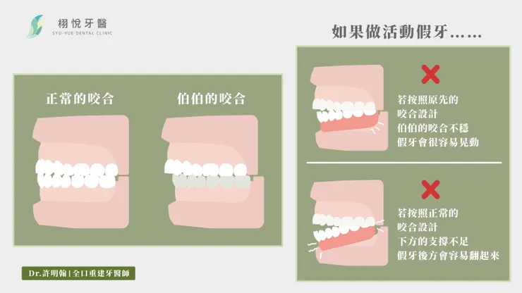 活動假牙與咬合關係