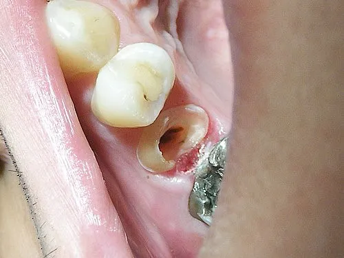 渥爾牙醫診所:斜裂小臼齒修復案例!Cap-Lock全瓷系列的完美應用(案例一)