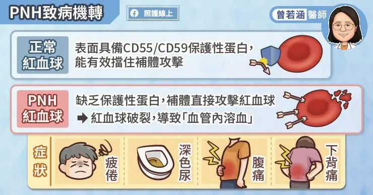 陣發性夜間血紅素尿症致病機轉