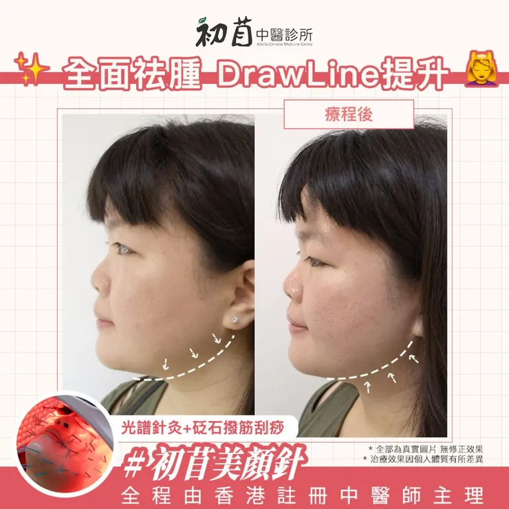 中醫美顏針 , 面部針灸 , 25歲後我開始容貌焦慮