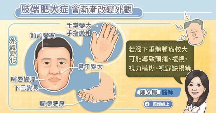 肢端肥大症會漸漸改變外觀