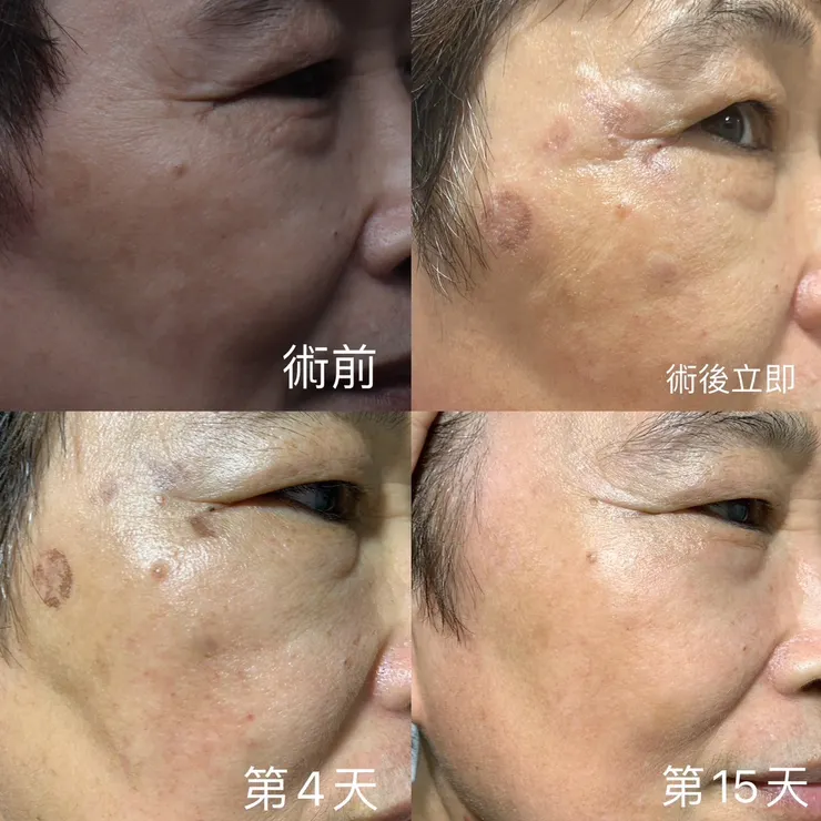 治療後15天