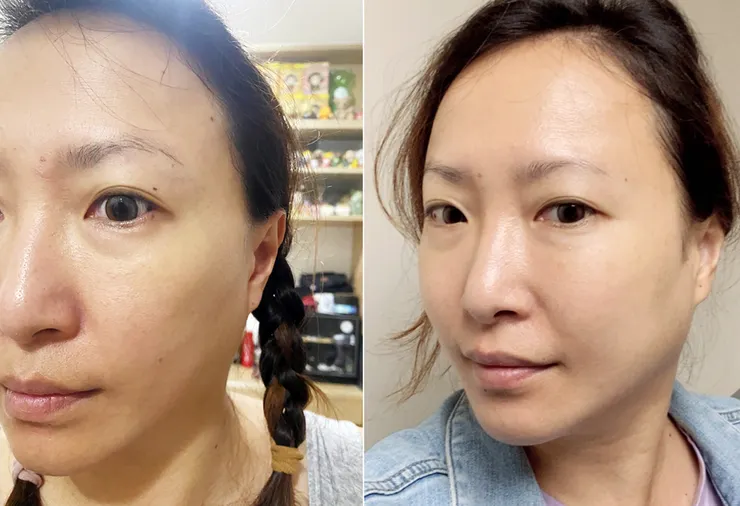 台北東區打雷射｜RedTouch PRO凍態雷射(果凍光)│台北打雷射推薦綻妍醫美診所