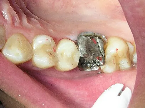 渥爾牙醫診所:斜裂小臼齒修復案例!Cap-Lock全瓷系列的完美應用(案例一)