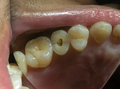 渥爾牙醫診所：小臼齒裂牙不拔牙，Cap-Lock全瓷修復保住原牙！