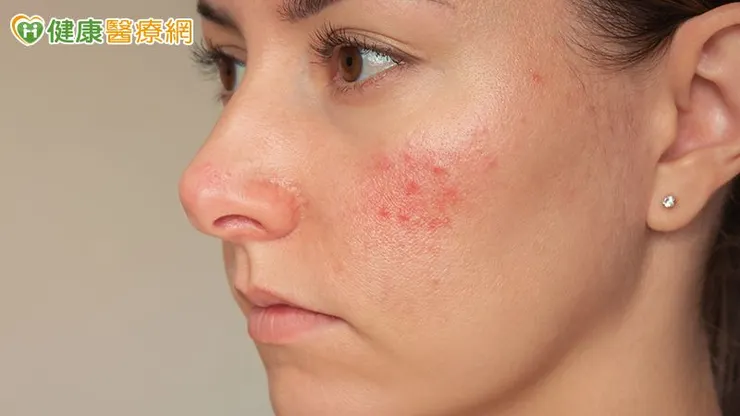 蒼藍鴿（吳其穎醫師）指出，酒糟鼻不一定因喝酒引起，但酒精會擴張血管、加劇紅腫，恐使症狀惡化。建議避開誘發因子，搭配專業治療調整膚況。