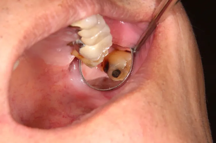 病人後來終於拔掉#28,可內可直接看到我之前在X光片看到的蛀牙,照給他看,他才相信