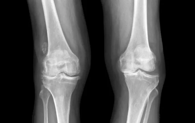 沐陽看護中心,沐陽特別護理中心,預防退化性關節炎