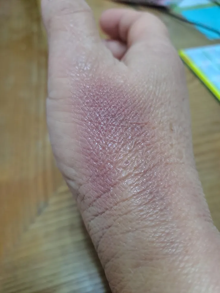 蒔緣右手手背，因漏針而腫脹、瘀青