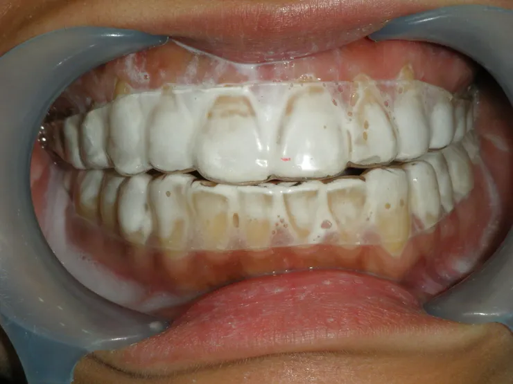 不要貪心塗太多像照片中此例，口水會一堆，會嗆到自己，不好入睡