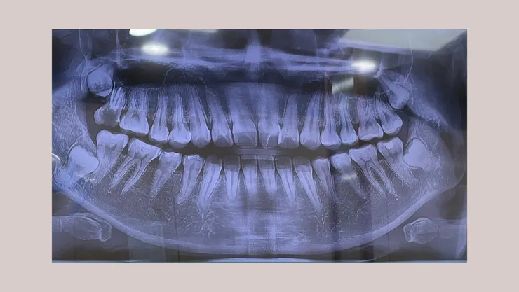 X 光正面照，明顯看見我的上排門牙開開的