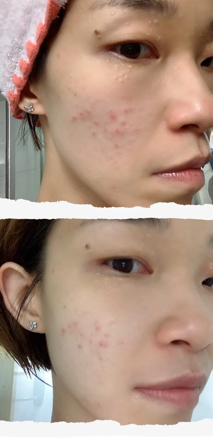 清潔做好,皮膚狀況就會慢慢變好