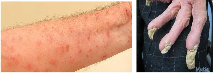 疥瘡感染照片(資料來源:網路)